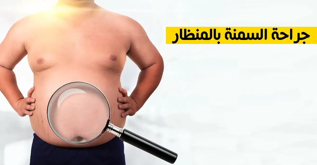 جراحة السمنة بالمنظار